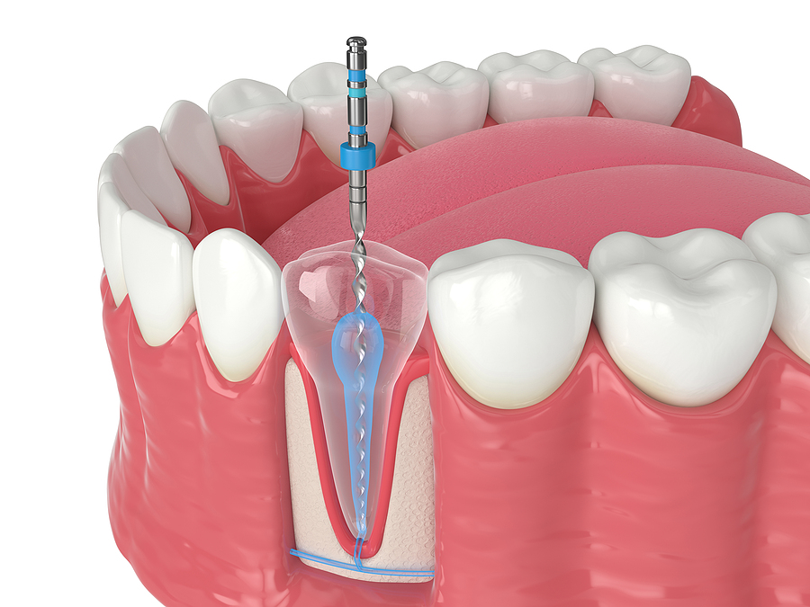 Preserving Oral Health: A Comprehensive Guide to Endodontics